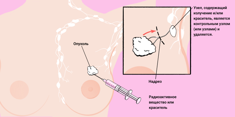 Как восстанавливают грудь после мастэктомии и рака молочной железы