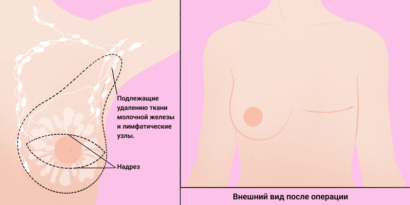 Как восстанавливают грудь после мастэктомии и рака молочной железы