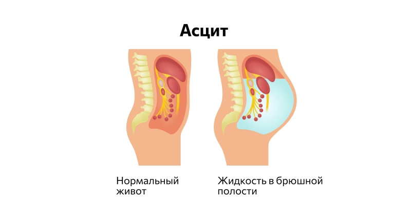 Может ли форма живота рассказать что-то о здоровье