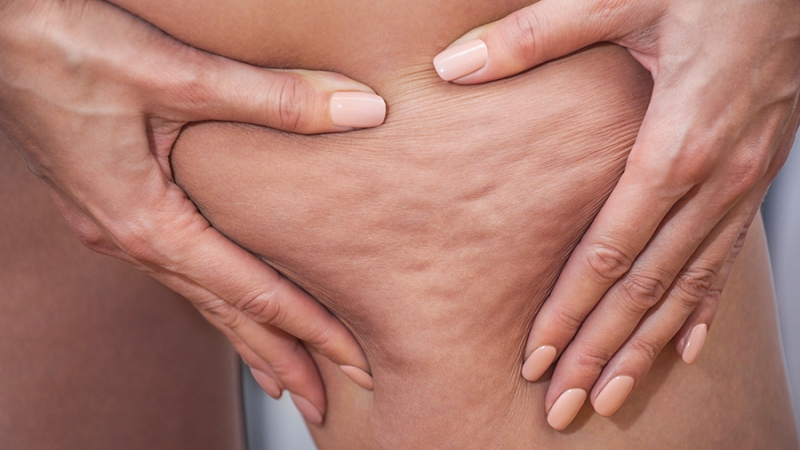 Врач перечислила провоцирующие целлюлит продукты